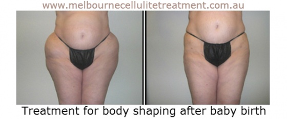 Melbourne Cellulite Treatment - Body After Baby