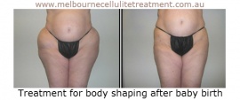 Melbourne Cellulite Treatment, Berwick
