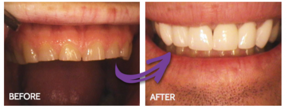 Mendelsohn Dental - teeth whitening