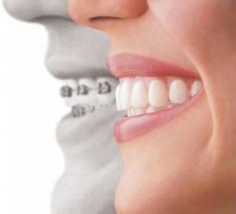 Freedom Dental - Invisalign
